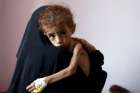 A woman holds a malnourished child at a hospital in Sanaa, Yemen, Oct. 6, 2018. Resolving the global crises of world hunger and malnutrition demands a shift away from a distorted approach to food and toward healthier lifestyles and just economic practices, Pope Francis said in an Oct. 16 message.